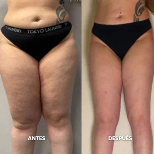 Lymphatic Drenaige: Elimina Lo Que Tu Cuerpo No Necesita 🧘🏻